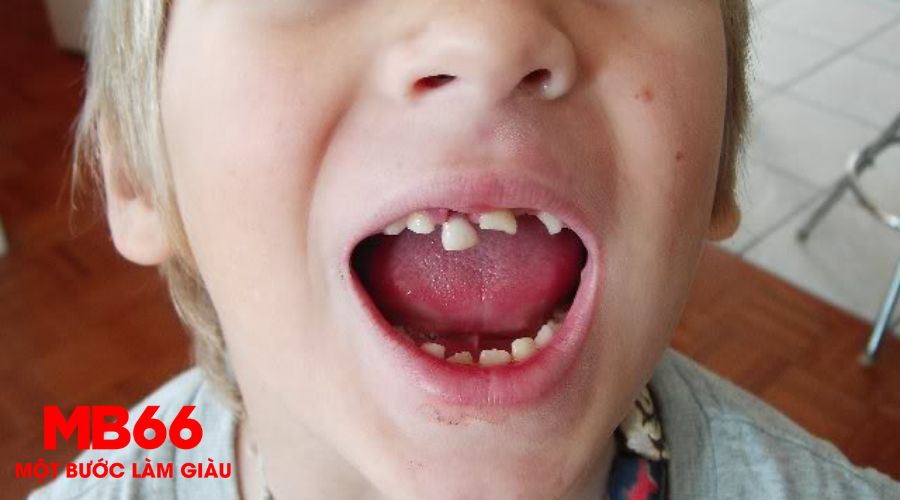 Mơ Thấy Rụng Răng Báo Hiệu Điềm Gì Và Nên Đánh Số Mấy? - UVION.WIN Mơ Thấy Rụng Răng Báo Hiệu Điềm Gì Và Nên Đánh Số Mấy? - UVION.WIN